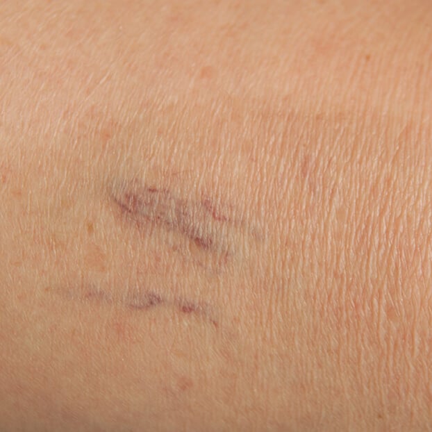 Besenreiser können auch verödet werden